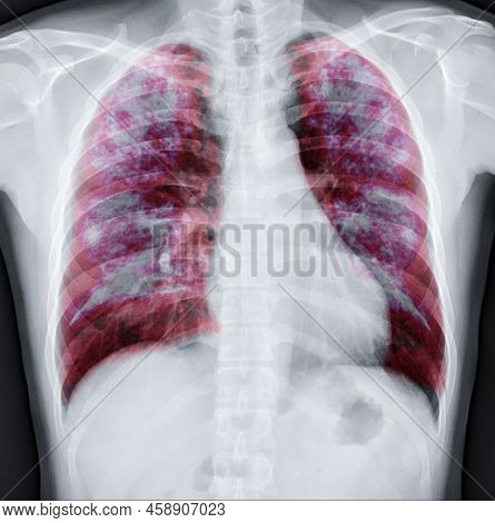 Lung 3D Rendering Image.