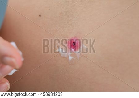 A Woman Smears Cream On A Wound After Burning A Wart.