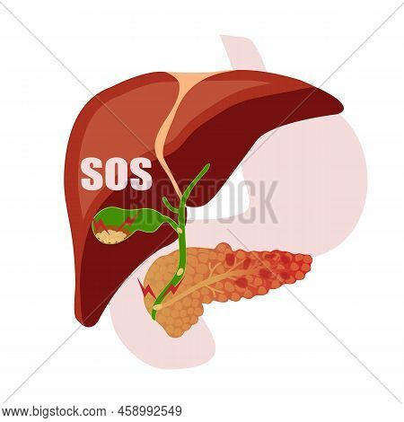 Illustration Showing Inflamed Pancreas, Gallstones Blocking Pancreatic Duct Vector Illustration.