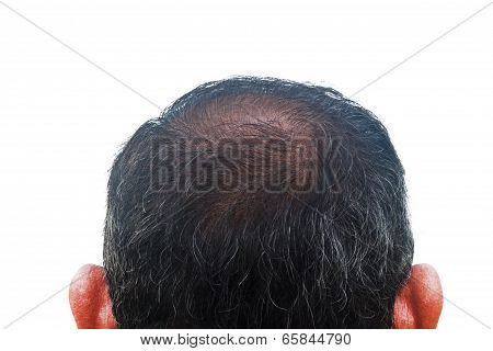 Hair Loss And Regeneration, Asian Man 55 Years Old.