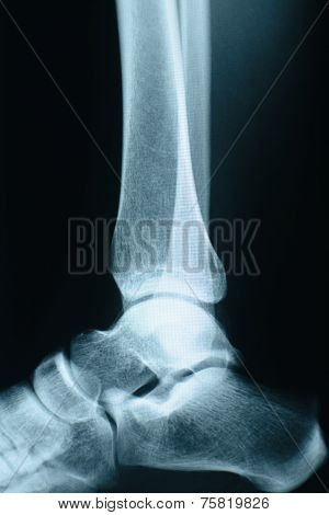 Ankle Xray