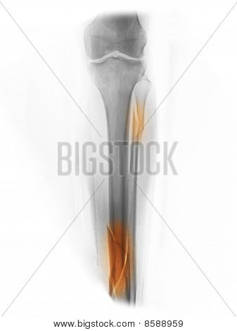 Raggi x mostrare fratture comminute di Tibia e perone In un uomo di 40 anni che è stato coinvolto In