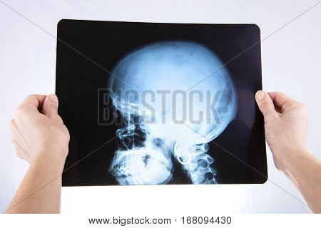 doctor holding X-rays of head