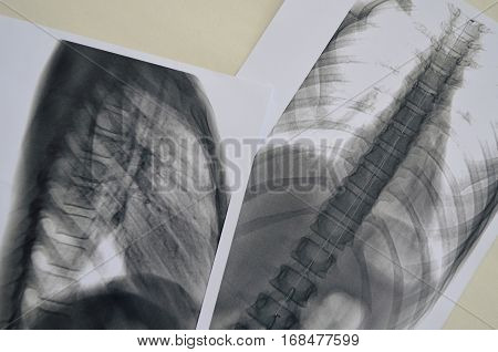 X-ray of a human spine - scoliosis diagnosis delivered by the expert