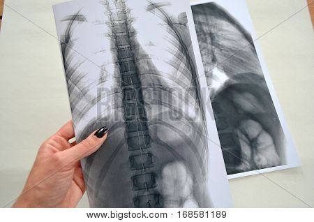 X-ray of a human spine - scoliosis diagnosis delivered by the expert
