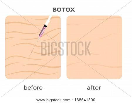 skin filler vector . It can cure the wrinkle