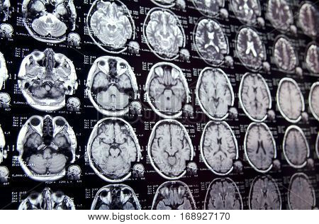 Closeup view of a MRI head scan with brain and skull on it with perspective. Blue toned.