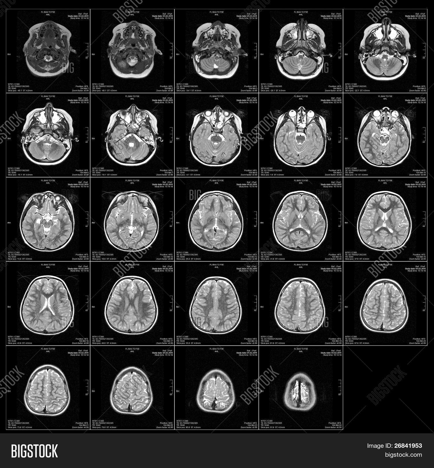 Real Brain MRI Slide Image & Photo (Free Trial) | Bigstock