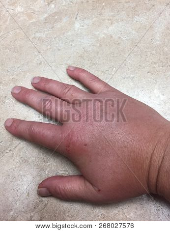 Closeup Of Swollen Hand With Bug Bite And Red Skin. White Female Hand And Fingers Swelling.