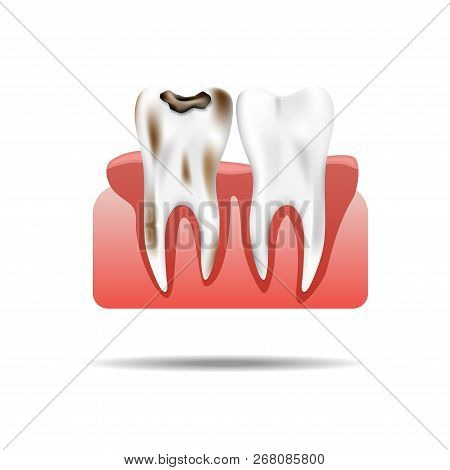 Enamel Caries Infection And Health Tooth  Realistic Pulpitis. Stomatology Health Care., Vector Illus