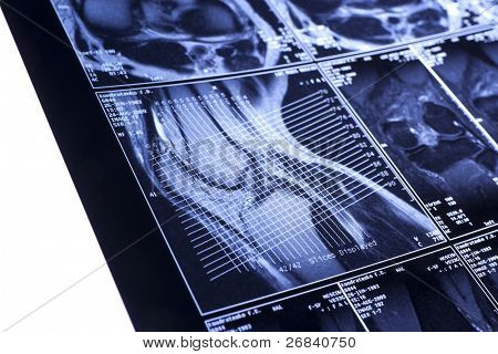 Moje koleno MRI - sportovní poranění, poškození vazů ve tvaru kříže