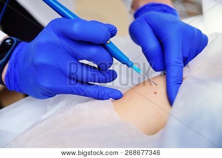 The Surgeon Beautician Removes The Patient's Woman Birthmark Or Birthmark On The Hand With A Radio W