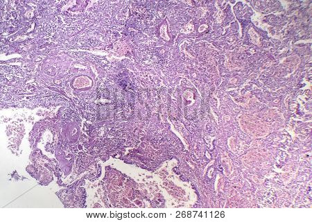 Histopathology Of Viral Pneumonia, Light Micrograph, Photo Under Microscope