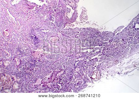 Histopathology Of Viral Pneumonia, Light Micrograph, Photo Under Microscope