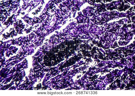 Histopathology Of Silicosis, The Most Prevalent Chronic Occupational Disease. Light Micrograph, Phot