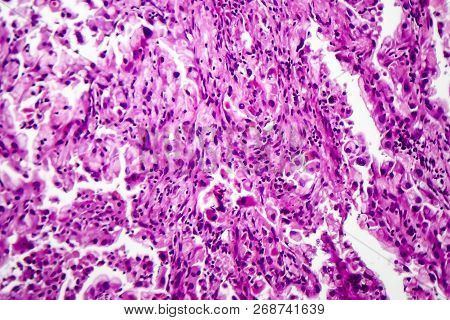 Histopathology Of Lung Cancer, Light Micrograph, Photo Under Microscope