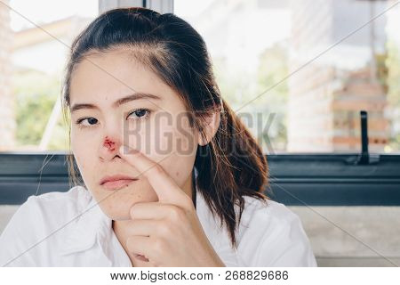 The Herpes Simplex On Asian Woman Nose, Herpes Simplex Is A Viral Disease Caused By The Herpes Simpl