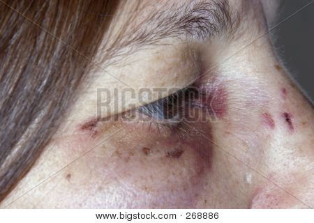 Blackeye3