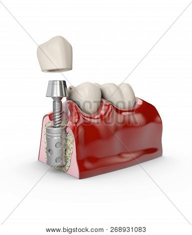 Anatomy Of Healthy Teeth And Dental Implant In Jaw Bone. Stomatology Concept 3d Illustration.