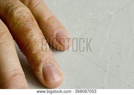 Closeup Of Eczema Dermatitis On Man Hand And Fingers. Skin Peeling,desquamation Of Hand, Gray Modern
