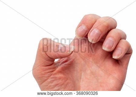 Close-up Of Brittle Nails, Female Hand On A White Isolated Background. Problematic Nails, Untreated 