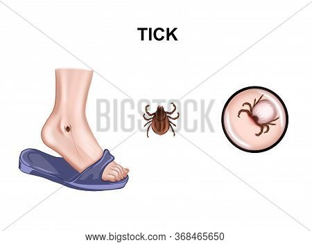 Illustration Of The Tick-borne Encephalitis Virus. Tick