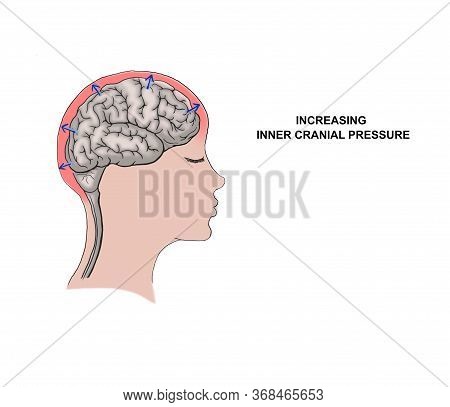Illustration Of The Increasing Inner Cranial Pressure.