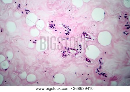 Breast Fibroadenosis, Light Micrograph, Photo Under Microscope. Common Benign Hyperplastic Process I