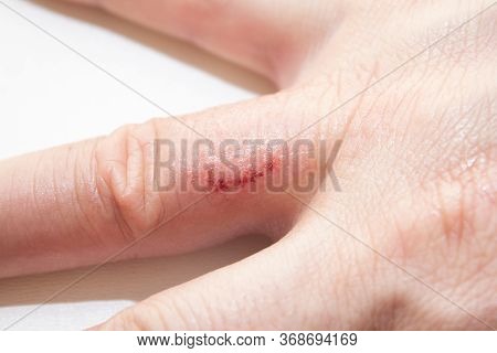 Hand Dermatitis. Hand Eczema Closed On White Background