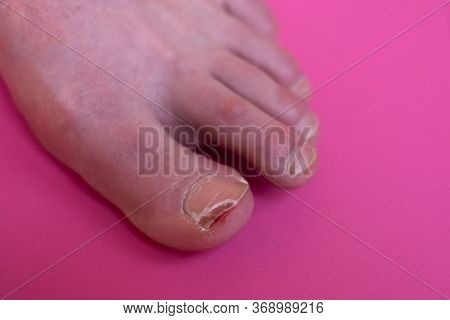Female Roken Toenail From Bump On Furniture.