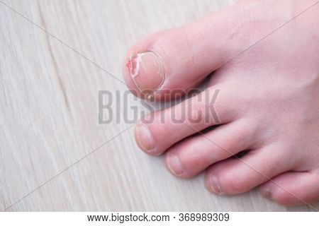 Female Roken Toenail From Bump On Furniture.