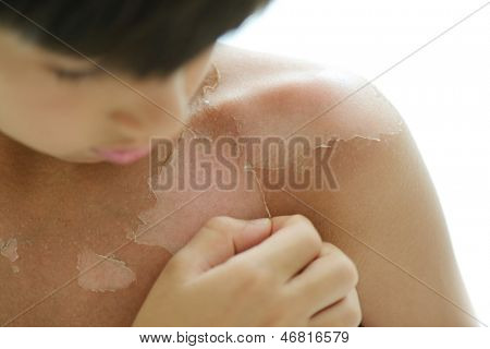 Dziecko mając kłopoty z łuszczenie skóry