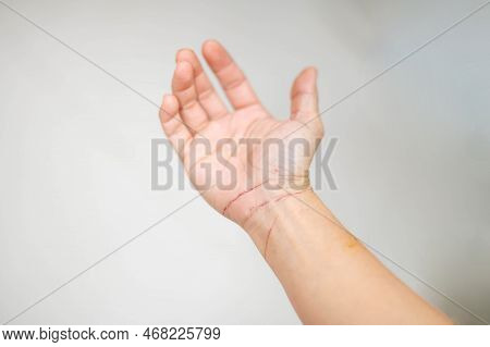 Female Hand Skin Condition After Cat Scratch And Bite Of Veterinary Surgeon Hand During Physical Exa