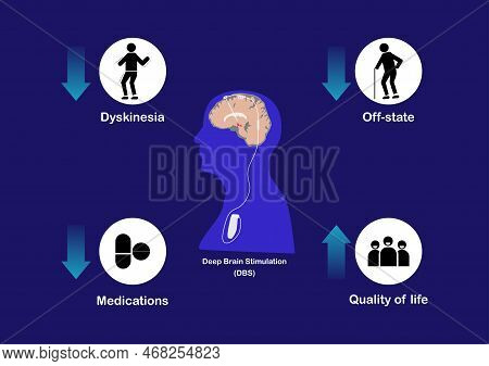 Effects Of Deep Brain Stimulation For Treatment Of Advanced Parkinson's Disease. Vector Illustration