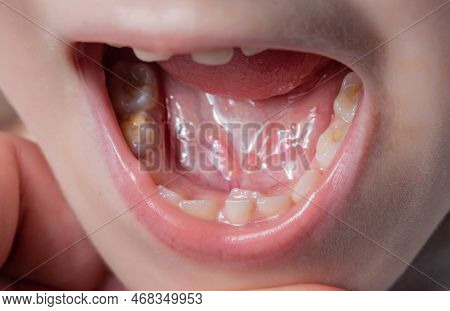 A Permanent Molar In A Child Grows Second Row. Incorrect Growth Of Molars Or Polyodontia In Dentistr