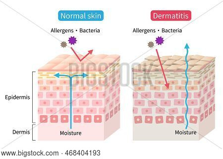 Atopic Dermatitis (eczema) Dry And Normal Skin Cell Layer  Illustration. Before And After. Healthy A