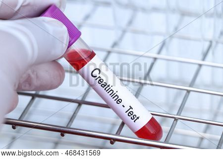 Creatinine Test To Look For Abnormalities From Blood,  Blood Sample To Analyze In The Laboratory, Bl