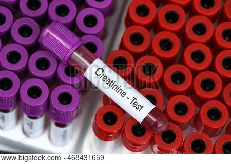 Creatinine Test To Look For Abnormalities From Blood,  Blood Sample To Analyze In The Laboratory, Bl