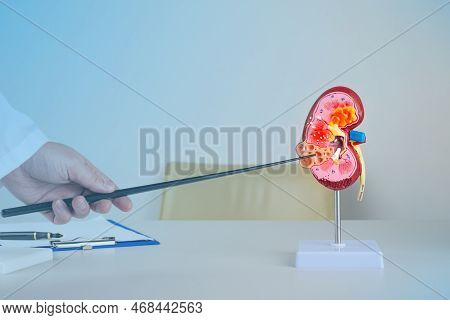 Doctor Nephrologist Pointing At Polycystic On A Kidney Mockup On His Desktop