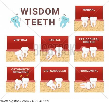 Wisdom Teeth Impaction Scheme Dentistry Medical Education Set Vector Flat Illustration