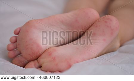 Eczema Is An Irritation Caused By An Allergic Lesion Of Skin Of Feet In Child. Infectious Skin Disea