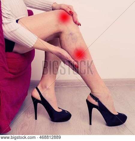 Painful Varicose And Spider Veins On Female Legs During Pregnancy. Woman Massaging Tired Leg