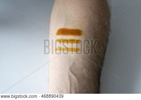 Iodine Strips On The Skin Of A Mans Hand. A Home Test To Determine Iodine Deficiency. Iodine Net On 