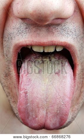 Disease Tongue
