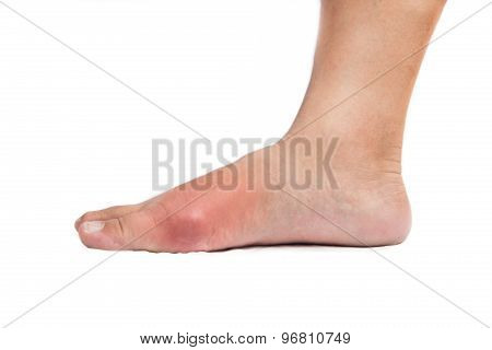 Painful gout inflammation on big toe joint of the foot
