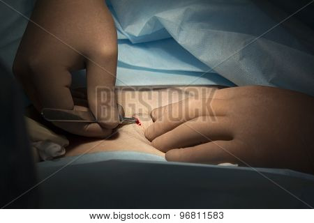 Surgical Incision Close-up