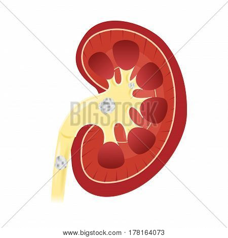 Kidney stones medical concept vector . anatomy
