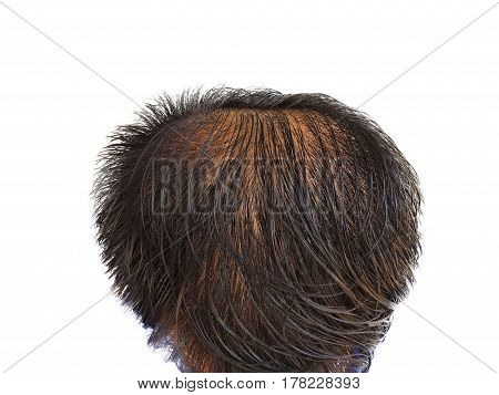 Characteristic symptoms of thinning hair,Glabrous,bald head on white blackground