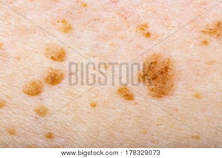 Close up photo of many nevus on human skin