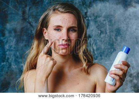 Young woman have allergy on body cream. Her face have a lot of acne and she is very unhappy.
